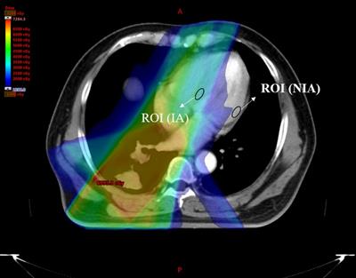 Early detection and serial monitoring during chemotherapy-radiation therapy: Using T1 and T2 mapping cardiac magnetic resonance imaging